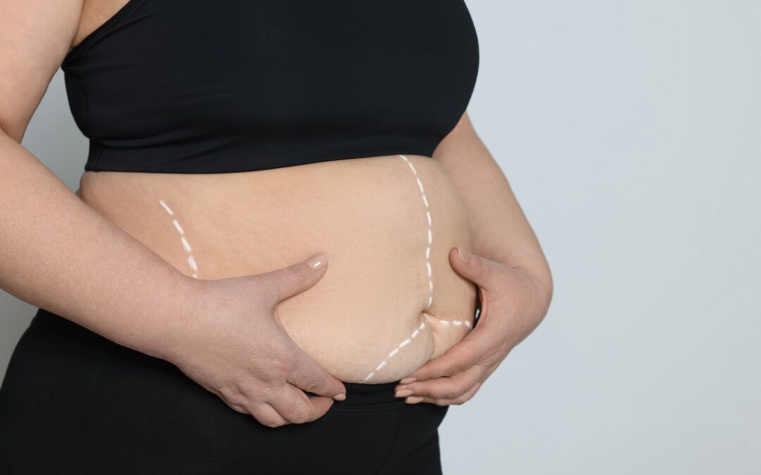 The Role of Bariatric Vitamins in Recovery and Long-Term Health