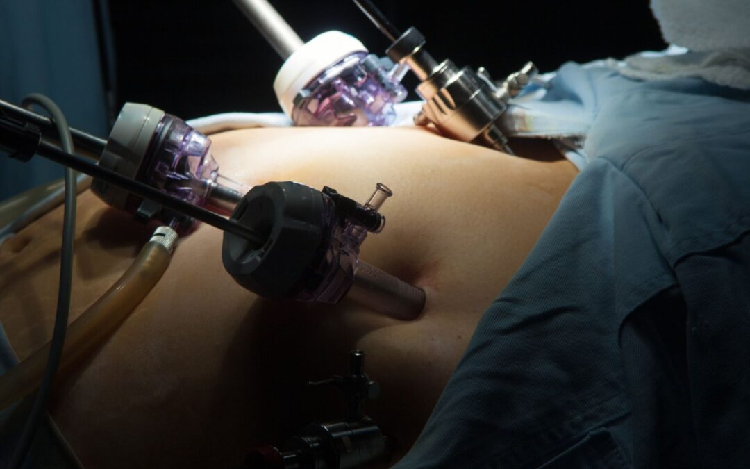 Sleeve Gastrectomy vs. Gastric Bypass: Pros, Cons, and Results